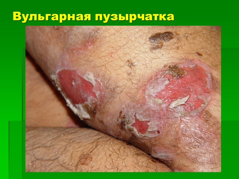 Вульгарная пузырчатка